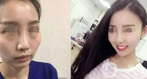 磨顴骨照片 磨顴骨*果怎么樣？