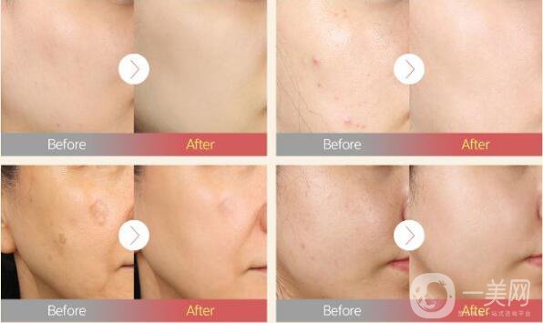 痤瘡調(diào)節(jié)方案 產(chǎn)生痤瘡的原因