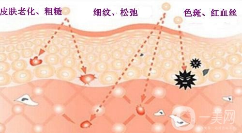 e光美容的副作用有哪些 e光美容反彈嗎 專家來解答