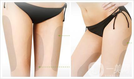 大腿抽脂需要多久恢復(fù)正常呢