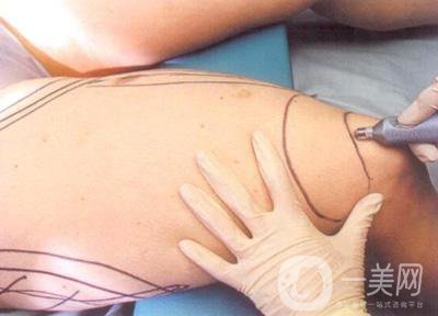 大腿抽脂需要多久恢復(fù)正常呢