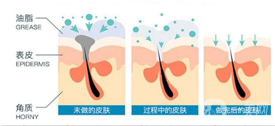 網(wǎng)紅小氣泡的功*與作用 網(wǎng)紅小氣泡的原理