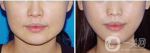 *一針多少錢,**價(jià)格