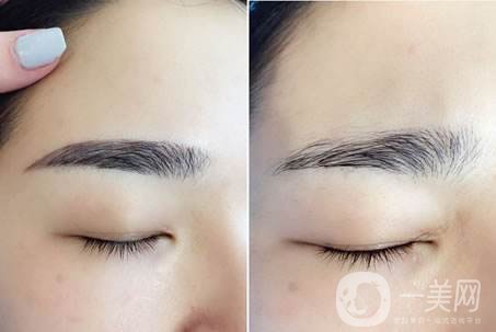 眉提升術(shù)恢復(fù)過程 提眉術(shù)多久恢復(fù)