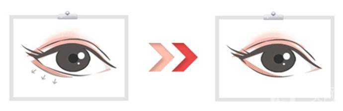 眼瞼提升術(shù)和下瞼眼瞼成形術(shù)的相關(guān)介紹