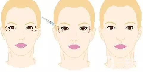 打一針除皺多少錢 打*停了會(huì)更老嗎