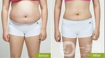 環(huán)形吸脂價(jià)格