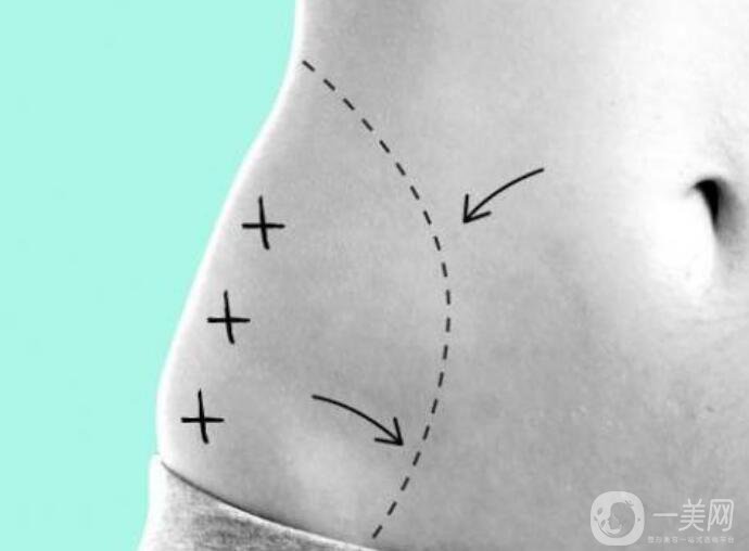 360度環(huán)形吸脂
