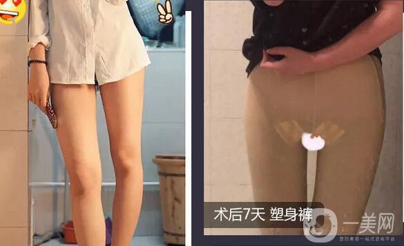 腿部環(huán)形抽脂*果