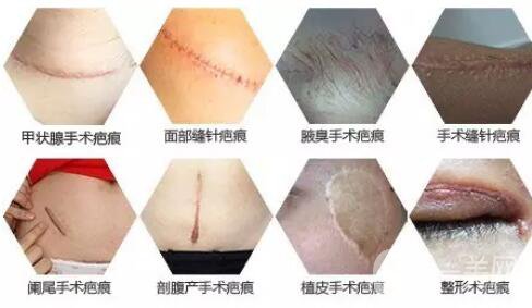 怎樣修復(fù)手術(shù)疤痕