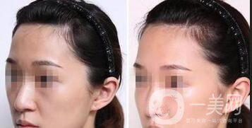 額頭自體脂肪,保持多久