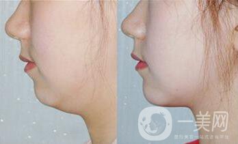 雙下巴抽脂術