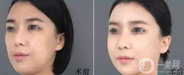 自體脂肪填下巴優(yōu)缺點(diǎn)介紹