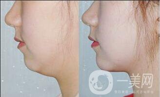 雙下巴抽脂術(shù)