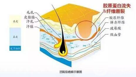 激光修復(fù)疤痕,副作用,凹陷疤痕