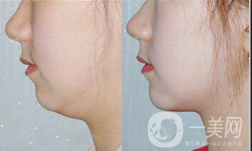 下巴抽脂多少錢,下巴抽脂注意事項