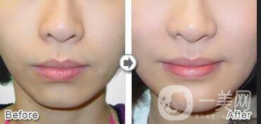 假體下巴風(fēng)險(xiǎn)