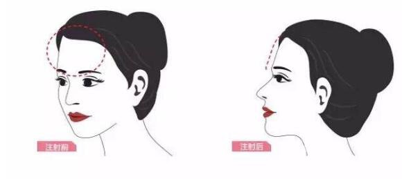 額頭自體脂肪多久消腫 額頭會不會發(fā)亮