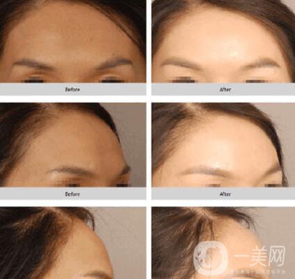 自體脂肪填充額頭多久恢復自然 整形專家這樣說