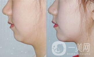 下巴抽脂,多久消腫