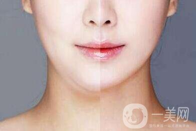 雙下巴抽脂,多久恢復(fù)