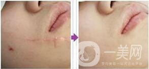 臉疤痕修復(fù)手術(shù)多少錢