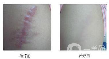 手術(shù)術(shù)后疤痕怎么修復(fù)