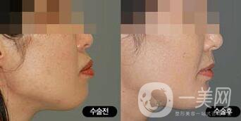 突嘴矯正手術(shù)危害