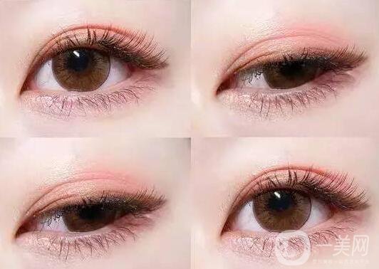 雙眼皮手術(shù),并發(fā)癥