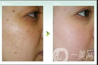 激光美膚副作用