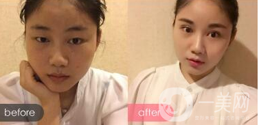 光纖溶脂價(jià)格 光纖溶脂瘦臉*果好嗎?