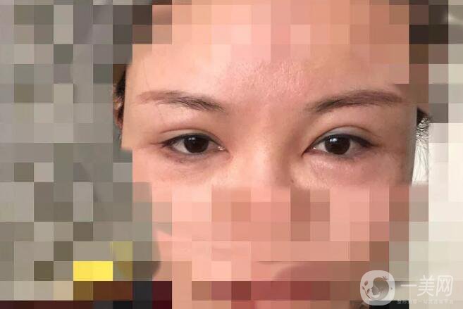 處楊曉楠雙眼皮案例 楊曉楠醫(yī)生怎么樣？