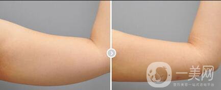 手臂舉升手術康復