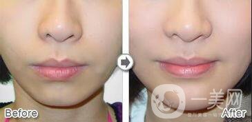 自體脂肪填充下巴