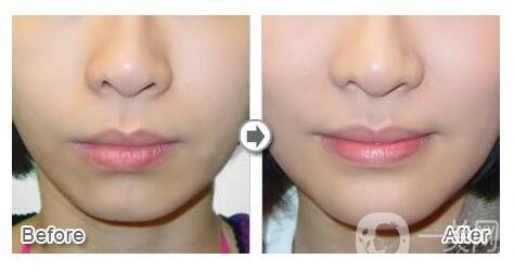 自體脂肪隆下巴利弊