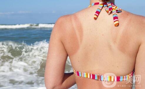 如何快速治好曬傷?來(lái)自*皮膚科醫(yī)生的15個(gè)提示