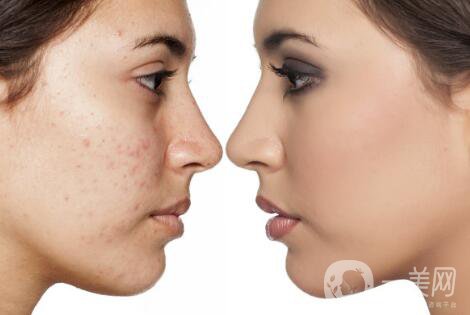 黑臉娃娃去痘*果好嗎？黑臉娃娃功*介紹