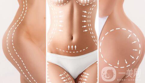 環(huán)形吸脂減肥是什么？吸脂后皮膚會(huì)不會(huì)松弛？