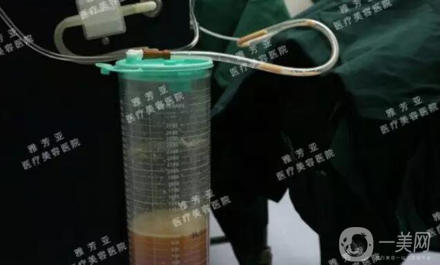 水動力溶脂減肥,*果