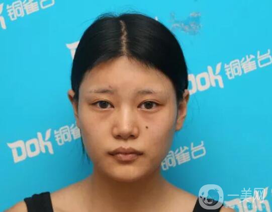 自體脂肪填充臉真人案例：路人到仙女的蛻變