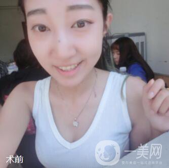 脂肪隆胸手術(shù)真實經(jīng)歷：過來人說說從A到C的改變