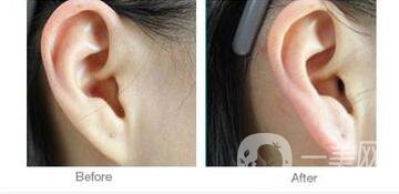 玻尿酸豐耳垂,價(jià)格,多少錢(qián)