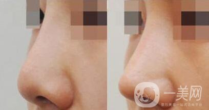 軟骨墊鼻尖,優(yōu)勢,修志夫