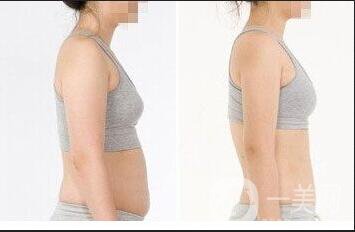 成都減肥抽脂價(jià)錢