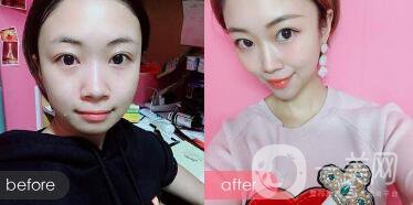 隆下巴手術(shù)前后*果圖 隆下巴的風(fēng)險(xiǎn)和恢復(fù)