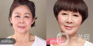 *對魚尾紋的作用：注射部位和副作用