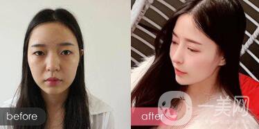 綜合鼻整形多少錢？綜合鼻整形收費(fèi)