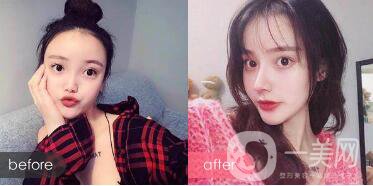 朝天鼻整形多少錢?*丑的幾種鼻子圖片