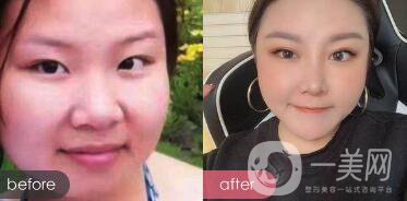 蒜頭鼻整形圖片 蒜頭鼻整形多少錢？