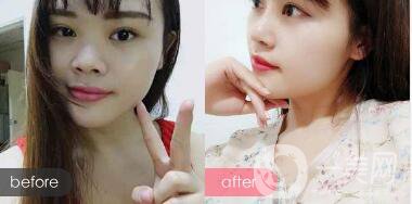 蒜頭鼻整形圖片 蒜頭鼻整形多少錢？